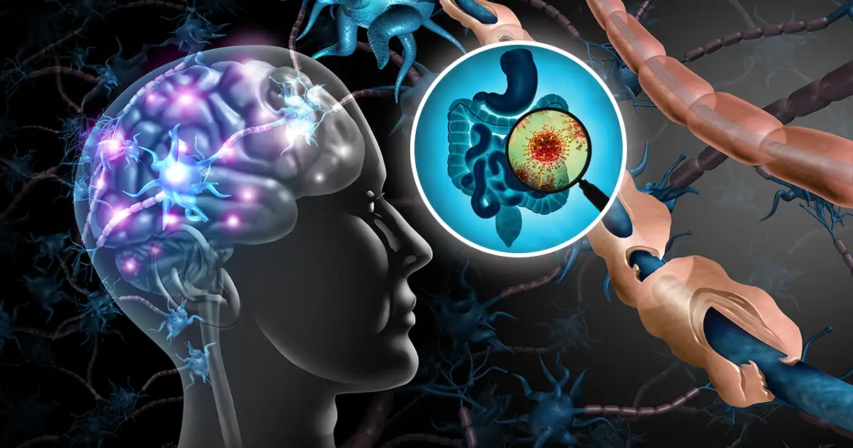 Niezrównoważona flora jelitowa została powiązana ze stwardnieniem rozsianym