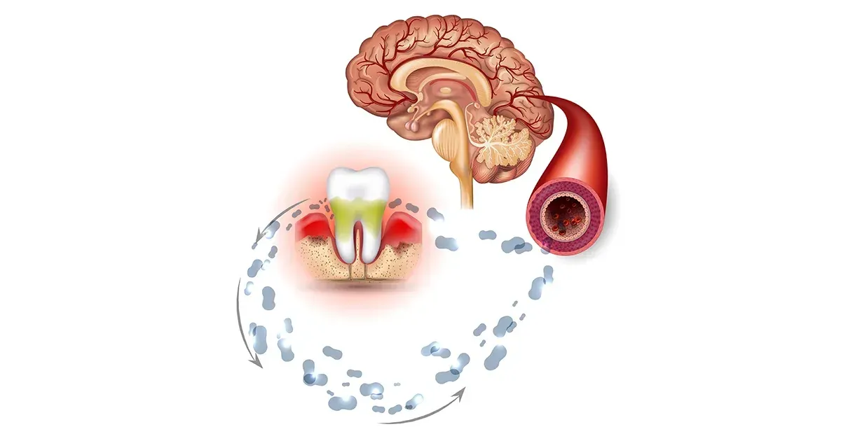 Jak mikrobiom jamy ustnej wpływa na ryzyko wystąpienia demencji?