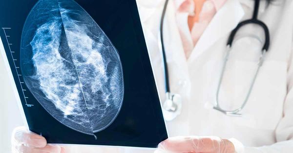 50% kobiet miało fałszywie dodatnią mammografię po 10 latach